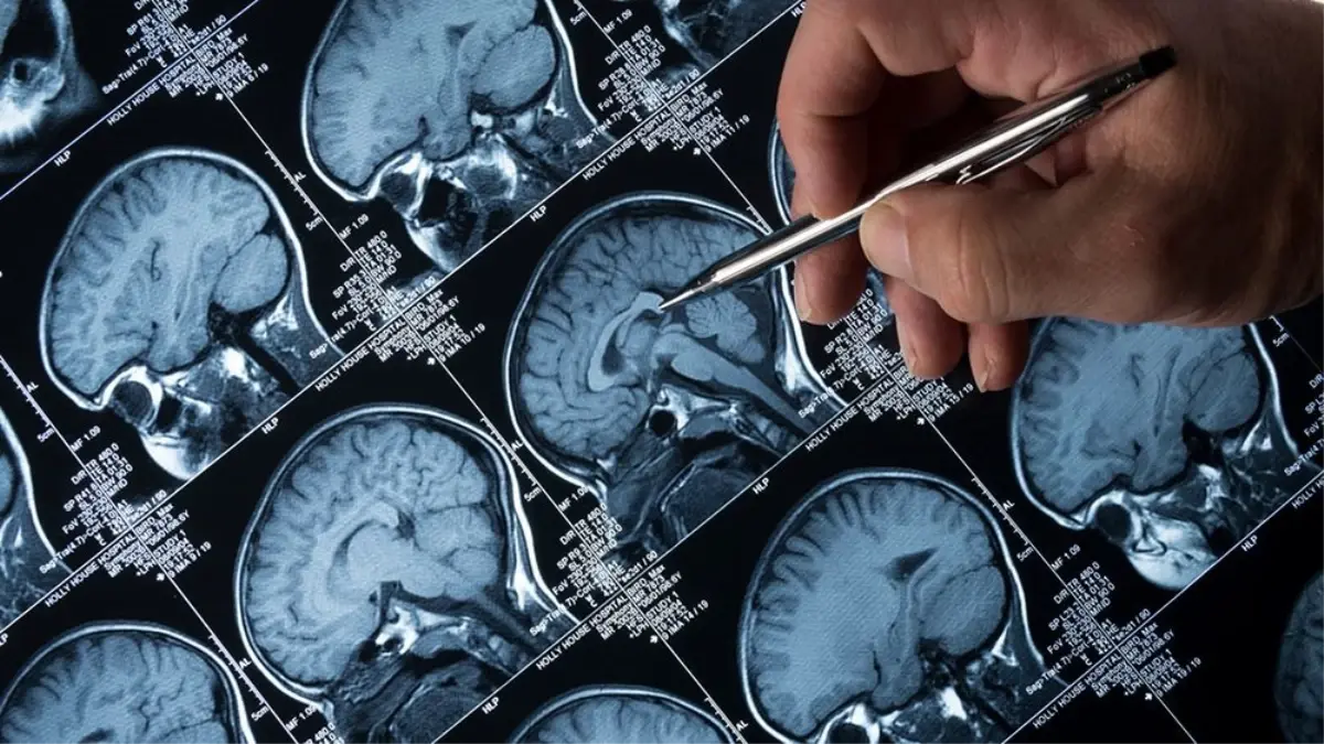 Lityum Alzheimer'ın İlerlemesini Etkileyebilir