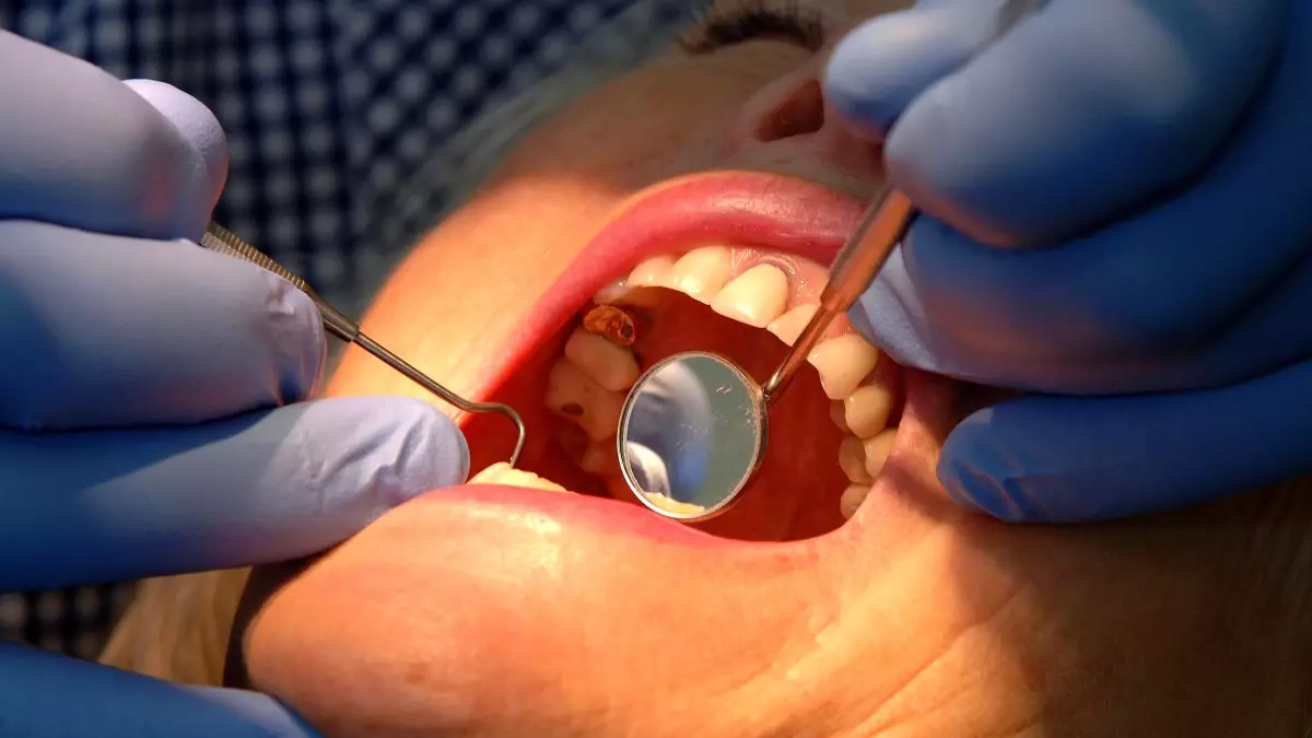 Yeni Diş Minesi Jeli Geliştirildi